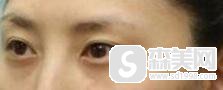 北京长虹医院口碑怎么样?双眼皮果好不好,附双眼皮案例前后果图
