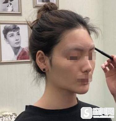 额头填充术价格是多少？附脂肪填充额头案例分享
