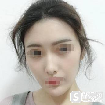 额头填充术价格是多少？附脂肪填充额头案例分享