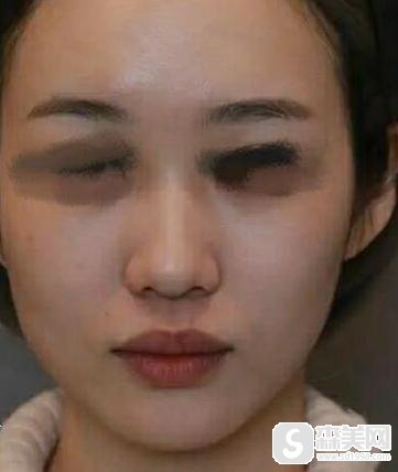 肋软骨隆鼻要花多少钱?附肋软骨隆鼻案例分享