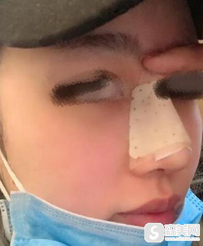 肋软骨隆鼻要花多少钱?附肋软骨隆鼻案例分享