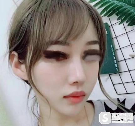 肋软骨隆鼻要花多少钱?附肋软骨隆鼻案例分享