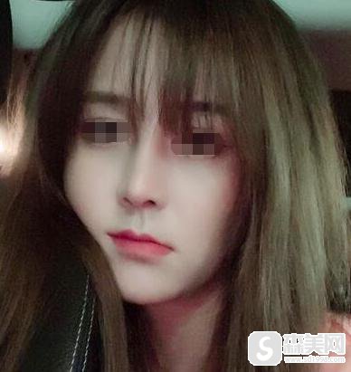 缩鼻头费用是多少?附缩鼻头案例分享+案例果前后对比图