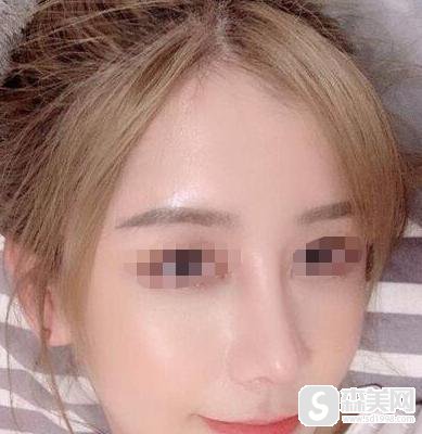 缩鼻头费用是多少?附缩鼻头案例分享+案例果前后对比图