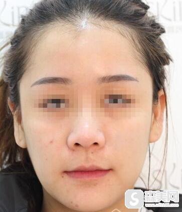 缩鼻头费用是多少?附缩鼻头案例分享+案例果前后对比图