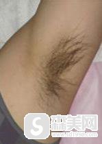 腋下脱毛多少钱?激光脱毛果怎么样?附激光脱毛前后果对比图