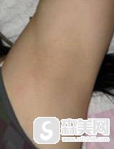 腋下脱毛多少钱?激光脱毛果怎么样?附激光脱毛前后果对比图