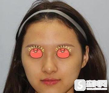 驼峰鼻价格是多少?附驼峰鼻矫正案例分享