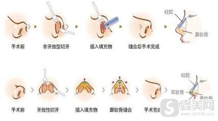 鼻翼缩小手术价格是多少？附鼻翼缩小案例分享＋手术前后果对比图