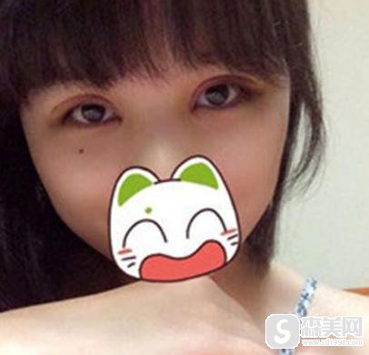 开外眼角手术怎么样疼不疼？附开外眼角案例分享