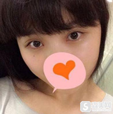 开外眼角手术怎么样疼不疼？附开外眼角案例分享