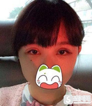 开外眼角手术怎么样疼不疼？附开外眼角案例分享