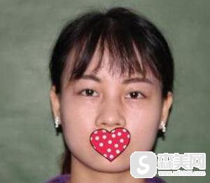 玻尿酸隆鼻价位怎么样?果怎么样?附玻尿酸隆鼻前后对比照