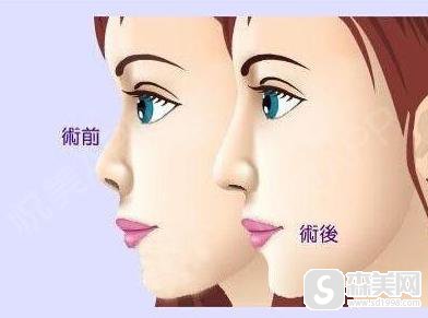 玻尿酸隆鼻价位怎么样?果怎么样?附玻尿酸隆鼻前后对比照