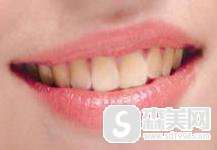 冷光美白牙齿多少钱？果怎么样？附牙齿冷光美白前后果对比图