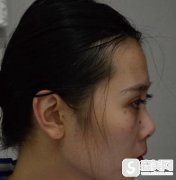 天津维美整形医院隆鼻好吗?附隆鼻案例分享+隆鼻注意问题