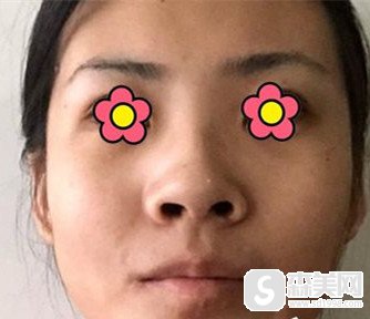 王介聪鼻部手术案例分享,做了鼻部手术以后我从一个平凡的路人变成了美女