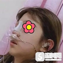 王介聪鼻部手术案例分享,做了鼻部手术以后我从一个平凡的路人变成了美女