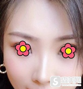 王介聪鼻部手术案例分享,做了鼻部手术以后我从一个平凡的路人变成了美女