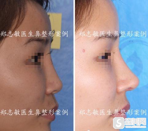 东莞美立方医疗美容隆鼻医生那个好？郑志敏医生隆鼻恢复果,隆鼻价格表