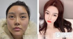 西南医院整形科价目表2020，奥美定取出价格怎么样，内含奥美定取出前后果图