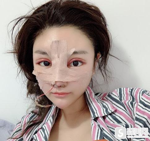 西南医院整形科价目表2020,奥美定取出价格怎么样,内含奥美定取出前后果图