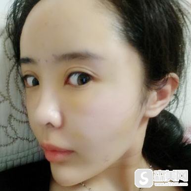 塘沽长征医院整形科价目表2020，填充价格，内含面部填充手术果图