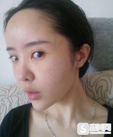 塘沽长征医院整形科价目表2020，填充价格，内含面部填充手术果图