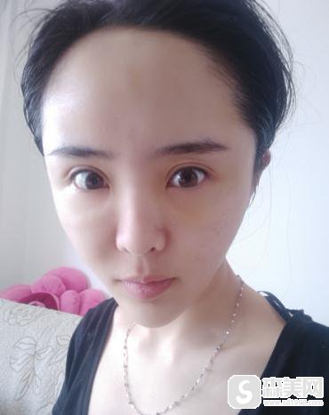 塘沽长征医院整形科价目表2020，填充价格，内含面部填充手术果图