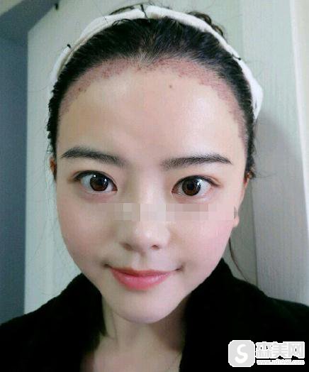 北京博士园植发医院价目表2021,植发价格,内含植发案例对比照片