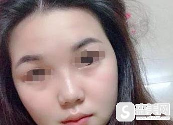 注射瘦脸的费用是多少？附注射瘦脸案例分享+案例果前后对比图