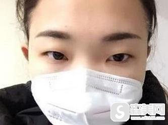 开内眼角多久恢复？适用于什么人群？附开眼角案例前后果对比