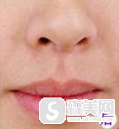 脸部激光脱毛要多少钱?果怎么样？附激光脱唇毛案例＋脱毛前后果对比图