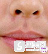 脸部激光脱毛要多少钱?果怎么样？附激光脱唇毛案例＋脱毛前后果对比图