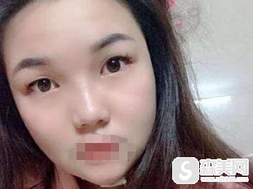 注射瘦脸多少钱?附注射瘦脸注射案例+注射前后果对比图