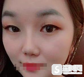 注射瘦脸多少钱?附注射瘦脸注射案例+注射前后果对比图