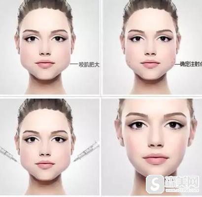注射瘦脸多少钱?附注射瘦脸注射案例+注射前后果对比图