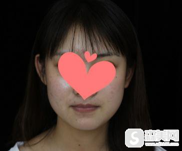 注射瘦脸的价格是多少?附注射瘦脸案例分享+案例前后对比图