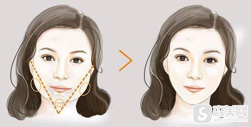 注射瘦脸的价格是多少?附注射瘦脸案例分享+案例前后对比图