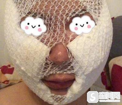 镭射溶脂价格?镭射溶脂果怎么样?镭射溶脂案例前后果对比图