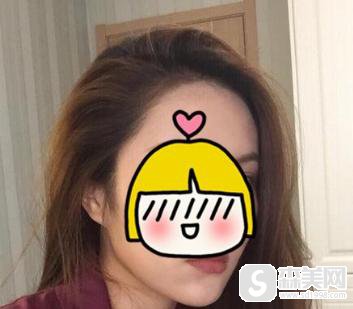 镭射溶脂价格?镭射溶脂果怎么样?镭射溶脂案例前后果对比图