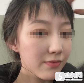 注射瘦脸注射要多少钱?附注射瘦脸案例分享+案例果前后对比图