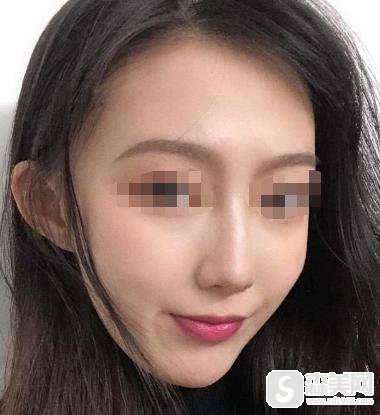 注射瘦脸注射要多少钱?附注射瘦脸案例分享+案例果前后对比图