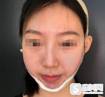 注射瘦脸注射要多少钱?附注射瘦脸案例分享+案例果前后对比图