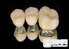 钯金烤瓷牙是什么？附钯金烤瓷牙案例前后果对比图