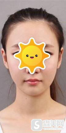 注射瘦脸的价钱?附加注射瘦脸手术案例果图+真人案例分享