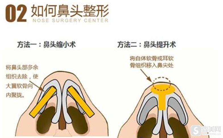 缩鼻头多少钱?附缩鼻头案例+前后果对比图