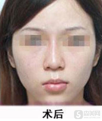 缩鼻头多少钱?附缩鼻头案例+前后果对比图