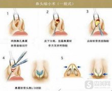 缩鼻头多少钱？附缩鼻头案例+前后果对比图