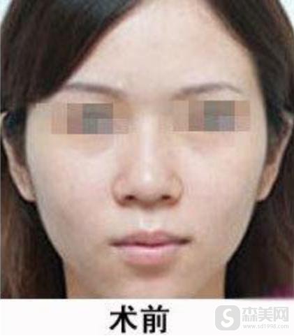 缩鼻头多少钱?附缩鼻头案例+前后果对比图